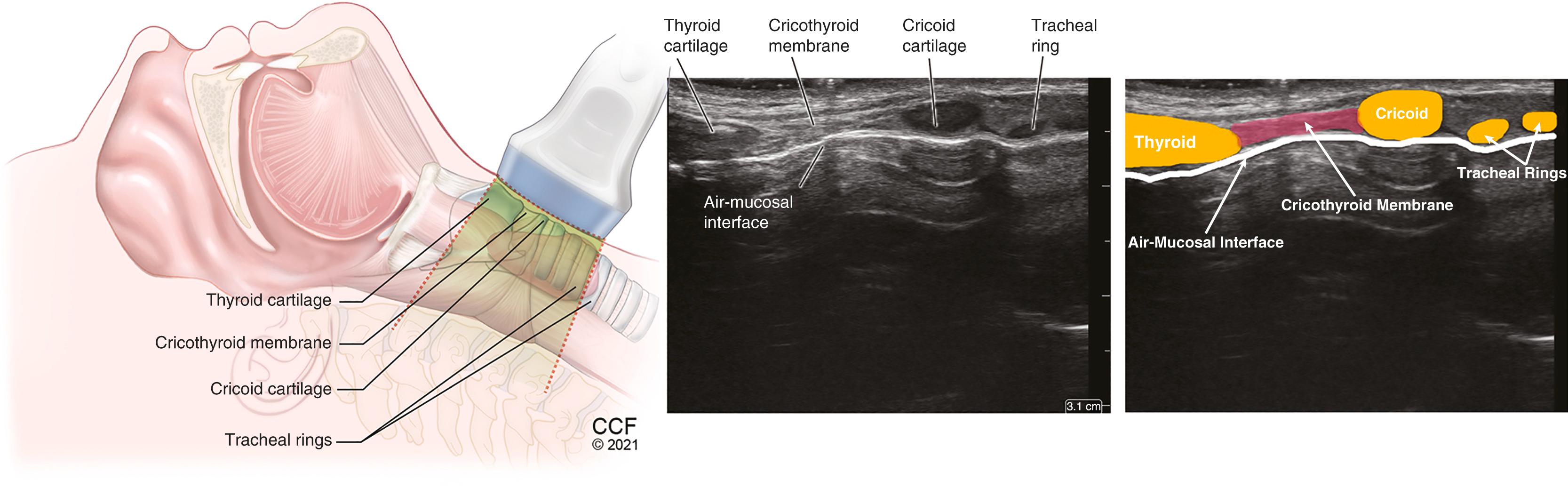 Figure 32.10, Midsagittal scan of the neck with a high-frequency, linear transducer over the suprasternal notch sliding up to thyroid cartilage.