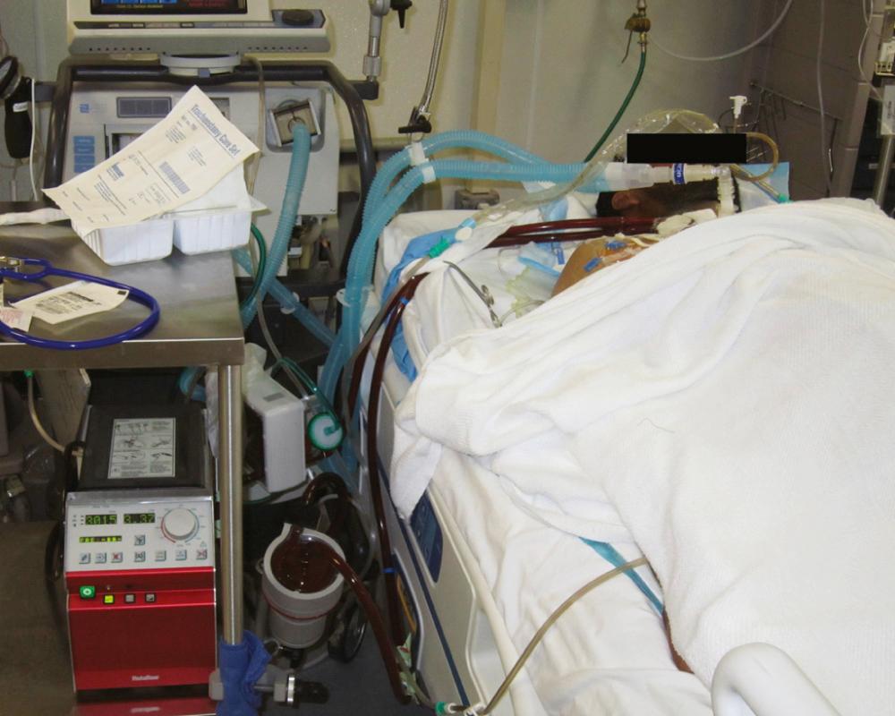 FIGURE 61-4, A combat casualty with severe respiratory failure managed with venovenous extracorporeal membrane oxygenation (VV ECMO).