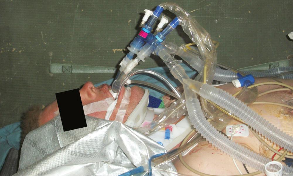 FIGURE 61-5, A combat casualty managed with independent lung ventilation.