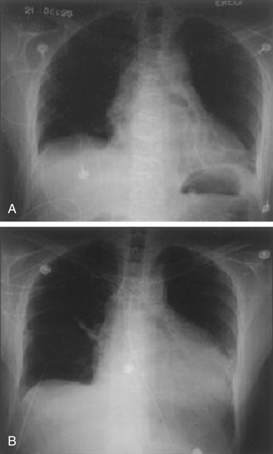 FIGURE 60-1, Post-pericardiotomy syndrome is commonly associated with pericardial and pleural effusions. A, Chest radiograph on a patient soon after aortic valve replacement shows expected postoperative findings. B, Chest radiograph 2 weeks later shows pericardial effusion compatible with the clinical symptoms of post-pericardiotomy syndrome.