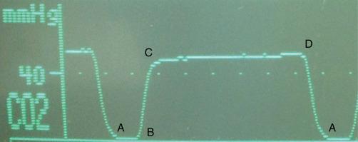 Figure 6-1, Normal capnogram. A and B, Dead space ventilation. B and C, Ascending expiratory phase (mixing of alveolar and dead space ventilation). C and D, Alveolar phase. D, End-tidal carbon dioxide. D to A , Inspiratory phase.