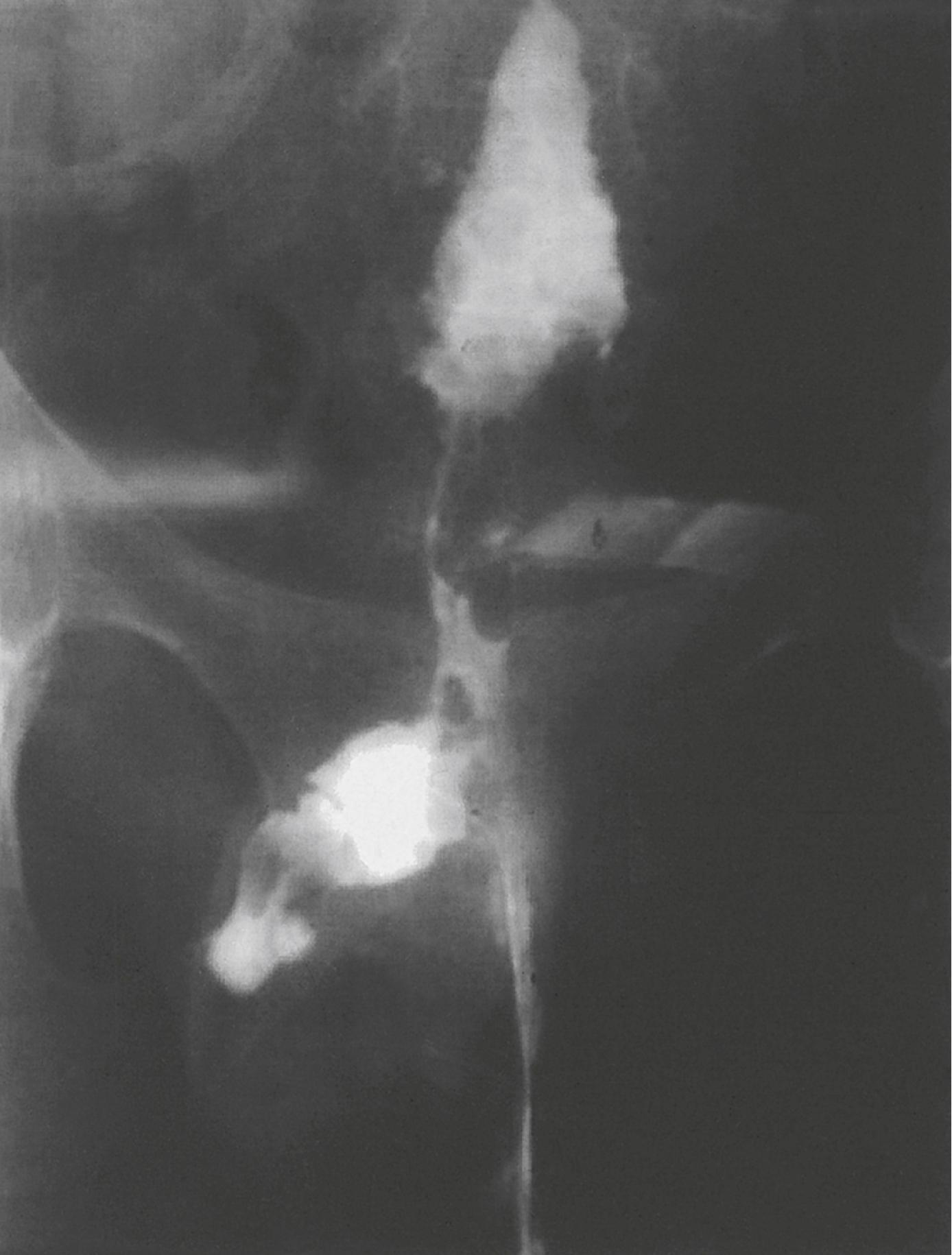 Figure 11.1, Sinogram examination demonstrating an enteroperineal fistula.