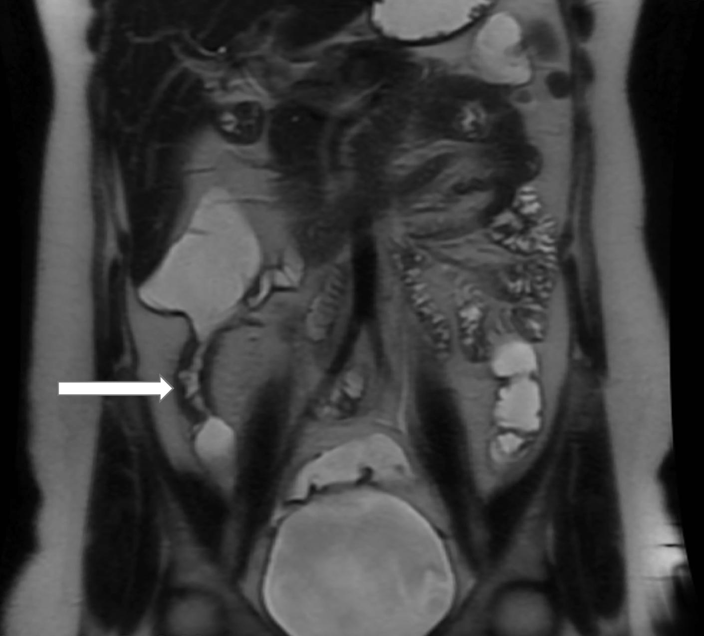 Figure 11.2, Magnetic resonance imaging (MRI) demonstrating strictured terminal ileum with thickened bowel wall ( arrow ).