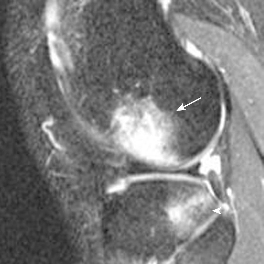 FIG 8.1, Sagittal T2 fat-saturated image demonstrates bone marrow edema, with the lateral femoral condyle (arrow) and the posterolateral tibia (arrowhead) representing osseous contusions secondary to a pivot-shift injury during a fall while skiing.