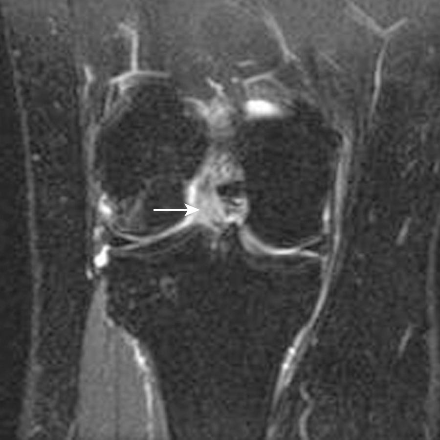 FIG 8.11, Coronal T2 fat-saturated image shows abnormal intrasubstance signal within intact anterior cruciate ligament fibers (arrow) compatible with partial tear in a 35-year-old snowboarder.