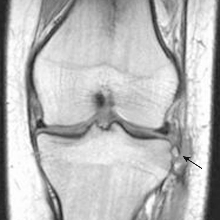 FIG 8.12, Coronal T1 image shows an avulsion fracture at the proximal tibia (arrow) , a Segond fracture, at the site of lateral capsular ligament insertion.