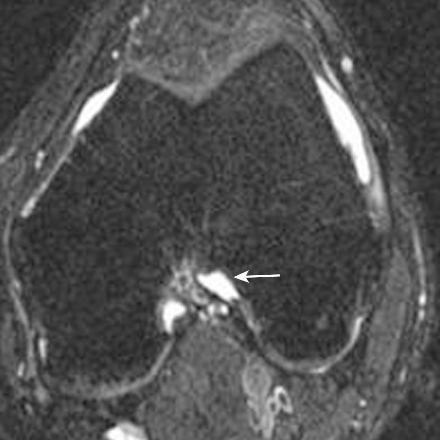 FIG 8.13, Axial T2 fat-saturated image shows absence of fibers at the lateral intercondylar notch (arrow) representing a chronic anterior cruciate ligament tear after a basketball injury.