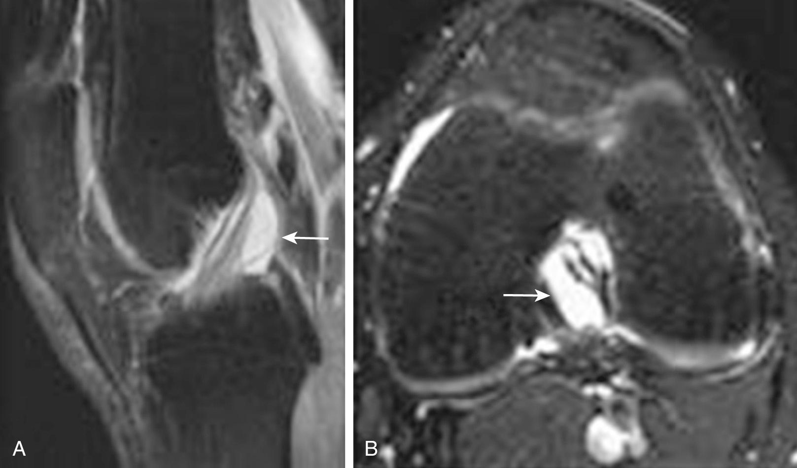 FIG 8.14, Sagittal (A) and axial (B) T2 fat-saturated images demonstrate loculated fluid extending along the length of the anterior cruciate ligament (arrows) representing an anterior cruciate ligament ganglion. Axial T2 fat-saturated image demonstrates a Baker cyst between the semimembranosus (arrow) and the medial head of the gastrocnemius (arrowhead) tendon. Axial T2 fat-saturated image demonstrates a ruptured Baker cyst with fluid dissecting along the subcutaneous tissues (arrow) .