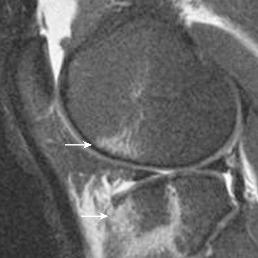 FIG 8.2, Sagittal T2 fat-saturated image shows bone marrow edema in the anterior tibia and femoral condyle compatible with osseous contusions (arrows) related to hyperextension injury in a 20-year-old soccer player.