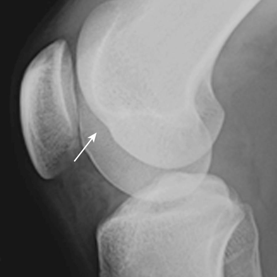 FIG 8.6, Radiographic lateral view of a knee demonstrating a deep sulcus sign at the lateral femoral condyle (arrow) .