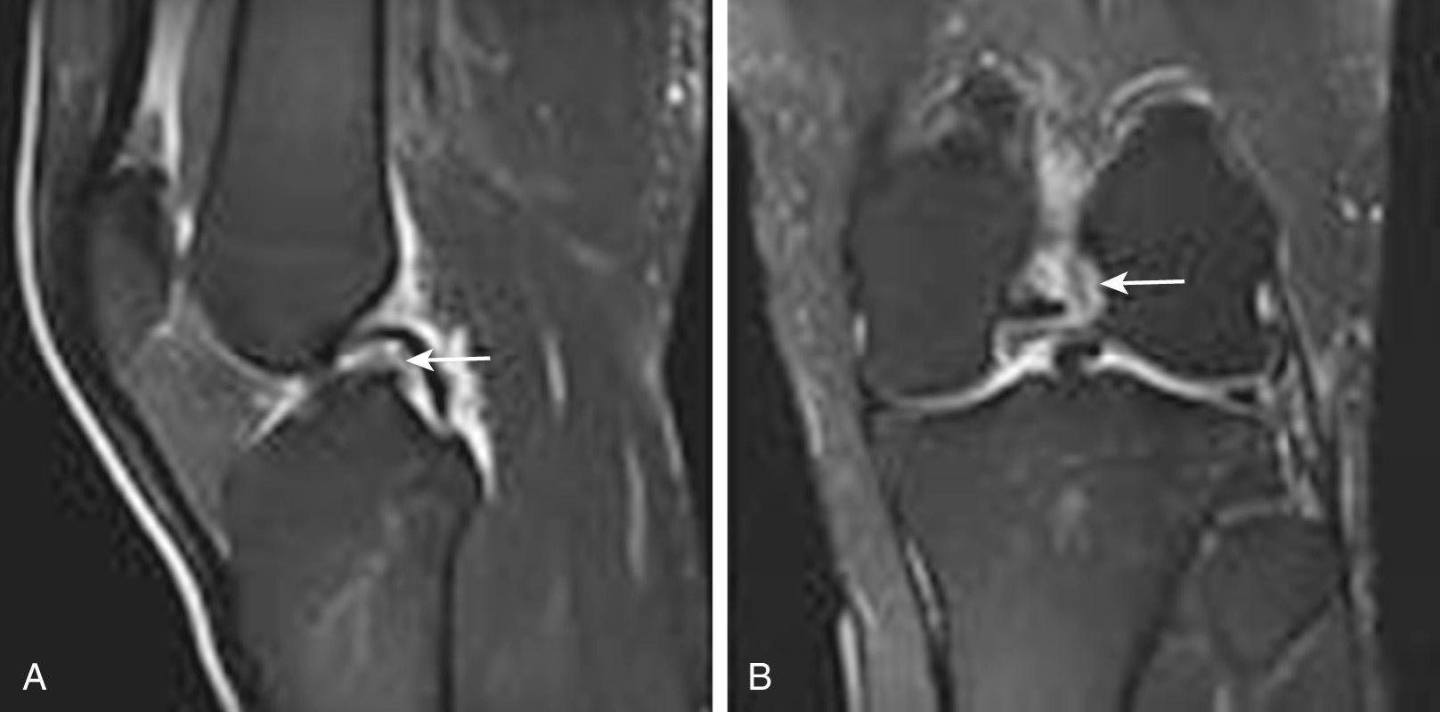 FIG 8.8, Sagittal (A) and coronal (B) T2 fat-saturated images show a complete anterior cruciate ligament tear. On the sagittal image (A), the fibers are horizontally oriented (arrow) . On the coronal image (B), hematoma replaces the expected location of the ligament (arrow) . Sagittal proton density image showing a normal anterior cruciate ligament (arrow) .