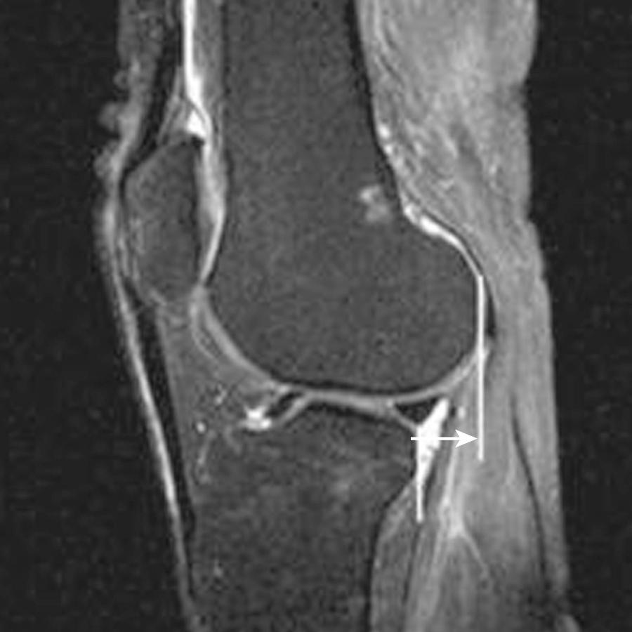 FIG 8.9, Sagittal T2 fat-saturated image shows anterior subluxation of the tibia with respect to the femur and demonstrates the measurement used to assess anterior drawer.