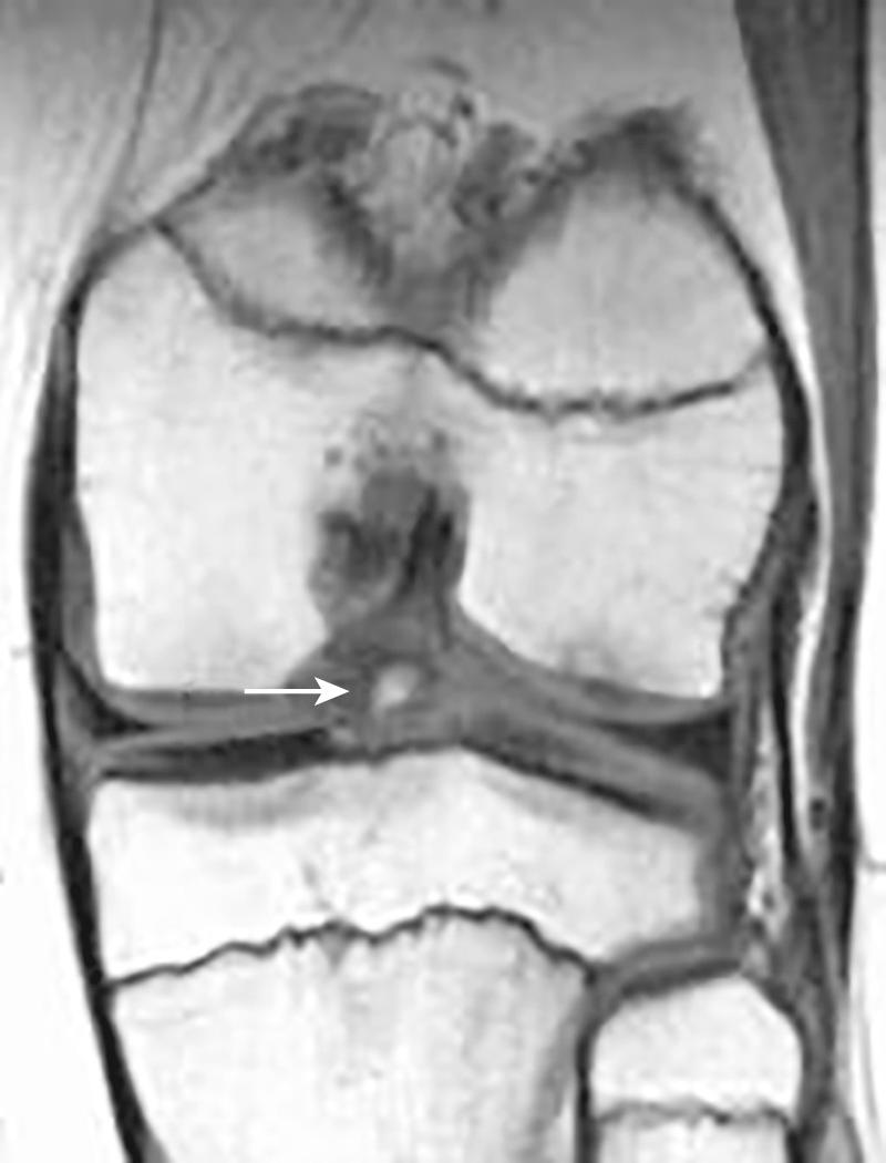 FIG 8.10, Coronal T1 image shows an avulsion fracture (arrow) of the intercondylar tibial eminence at the anterior cruciate ligament insertion in a skeletally immature 12-year-old football player.