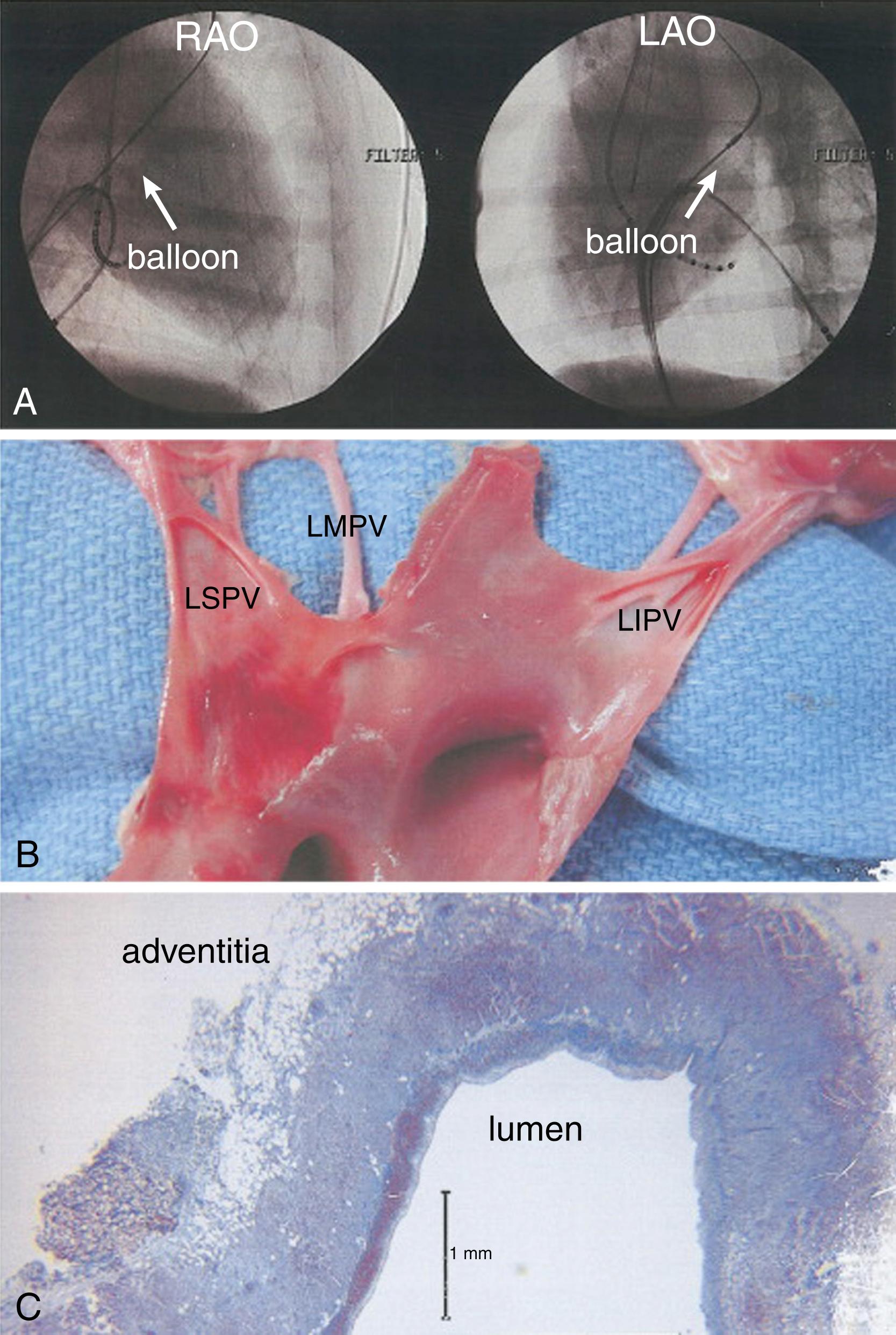 Fig. 131.1, Complete circumferential and transmural lesion at the venoatrial junction of the left superior pulmonary vein (LSPV) with cryoablation in a canine model.