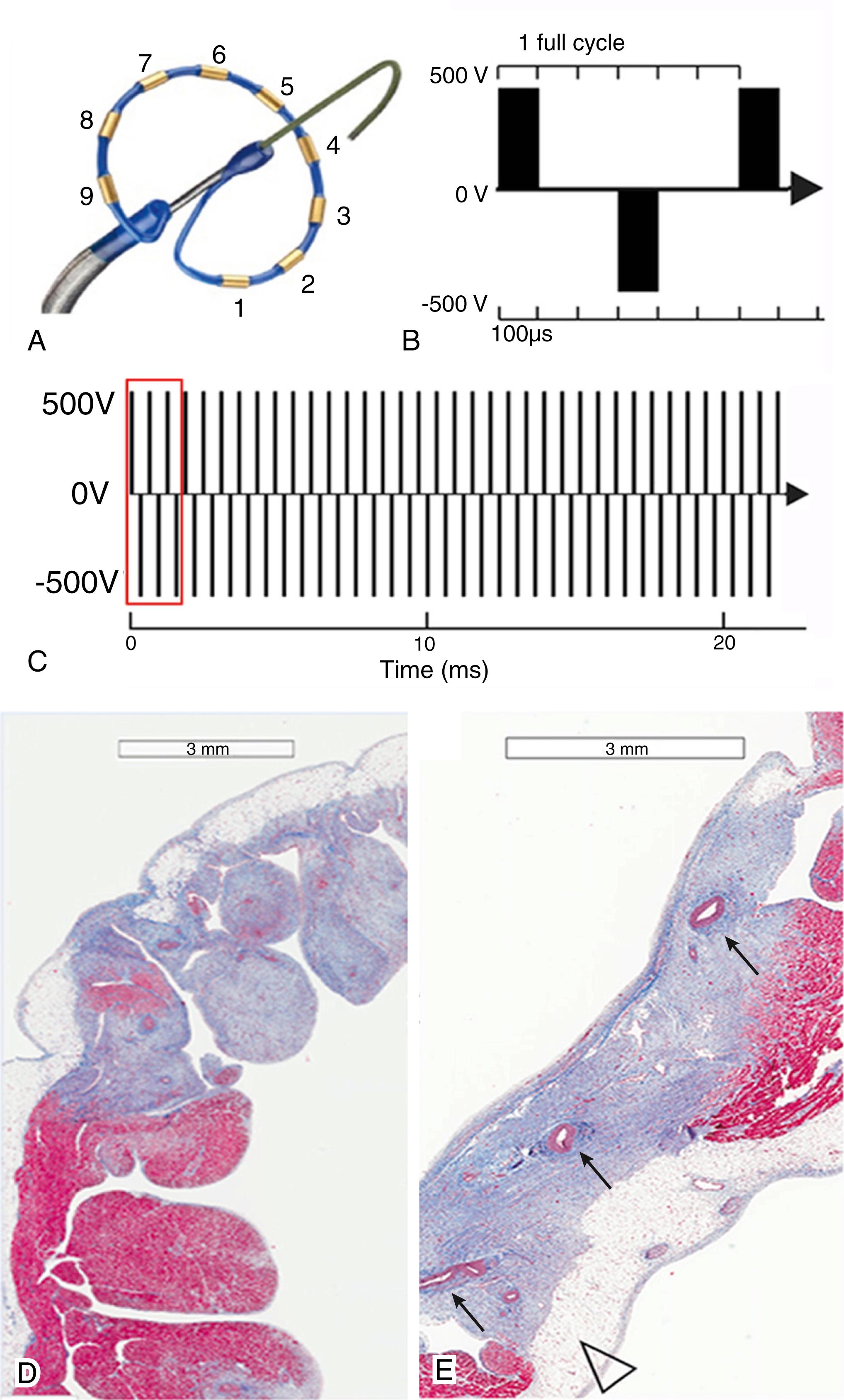 Fig. 131.2, Multielectrode circular array catheter used for bipolar pulsed field ablation (PFA) deliveries (A), shown with electrode numbering designation. Detail of three biphasic pulses (B) delivered at the start ( red box ) of a train of 60 pulses (C) with a train delivery duration of 36 ms. Low magnification histologic cross sections of the right atrial appendage of a pig that underwent PFA 2 weeks earlier (D–E) show the uniform appearance of the immature replacement fibrosis ( blue ) without hemorrhage. The epicardial fat over the transmural PFA lesion is widely normal (D, arrow ), and several fully patent intralesional arteries are present (E, arrows ). Masson’s trichrome stain.