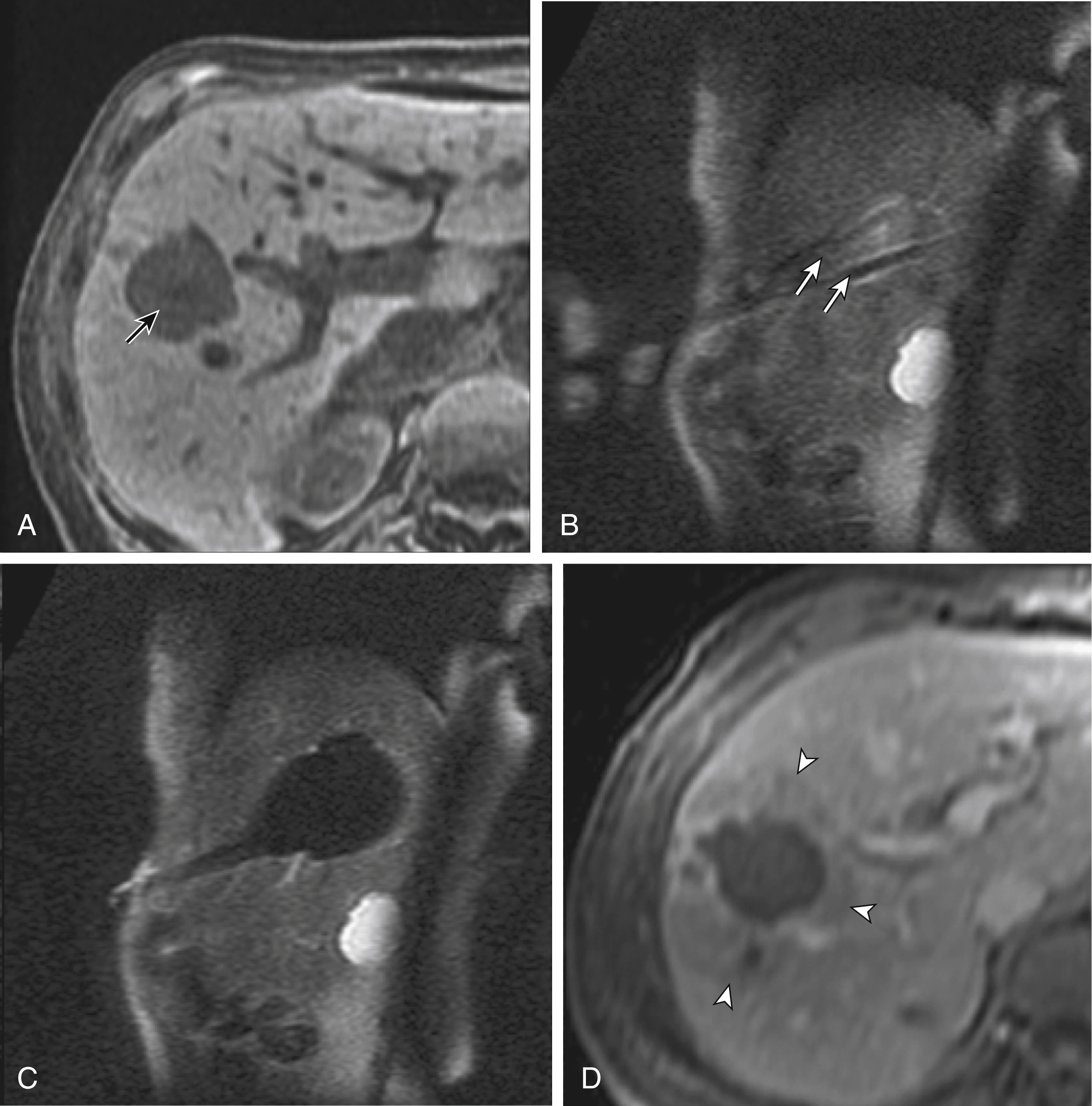 Fig. 98.1, (A) Axial contrast-enhanced magnetic resonance image (MR) shows a large minimally enhancing liver metastasis ( arrow ) from a primary breast cancer. (B) T2 oblique sagittal image shows intraprocedural MRI-guided placement of multiple cryoprobes ( arrows ) into the hyperintense tumor. (C) T2 oblique sagittal image shows a hypointense iceball after 15 minutes of freezing. (D) Axial contrast-enhanced MRI shows the treated tumor surrounded by a nonenhancing margin of ablated normal tissue ( arrowheads ) 24 hours after the procedure.