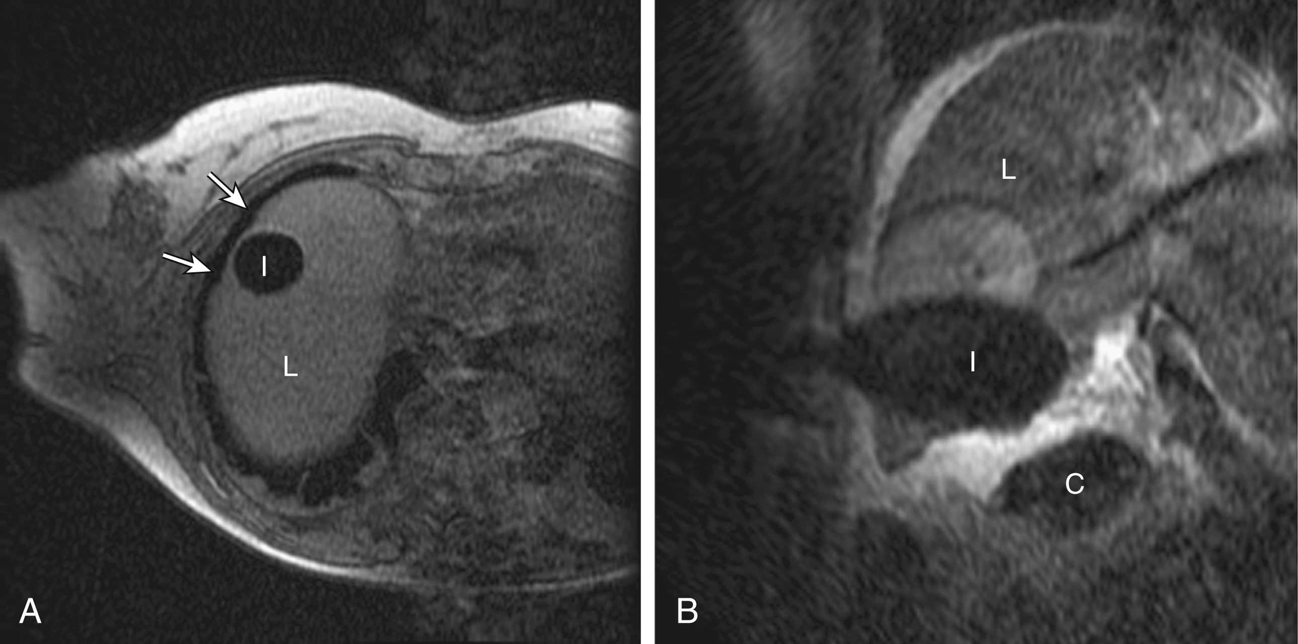 Fig. 98.2, Image-guided control demonstrated in two separate ablation procedures. (A) Intraprocedural axial T1 magnetic resonance image (MRI) shows critical relationships several minutes into a multiprobe freeze of a liver metastasis in the dome of the liver. The iceball ( I ) within the liver ( L ) is observed as its lateral edge approaches adjacent lung ( arrows ). Such clear visualization of the field allows the radiologist to adjust the rate of freezing to protect normal tissues. (B) Intraprocedural coronal T2 MRI provides guidance to protect adjacent structures by additional interventional techniques. The multiprobe freezing of a metastasis is conducted in the liver ( L ). The colon ( C ) is protected from the iceball ( I ) because it has been distanced by hydrodissection, the injection of saline through additional percutaneous needles (not seen in the image plane). 61 The saline is seen here as the hyperintense region between the ice ( I ) and colon ( C ).