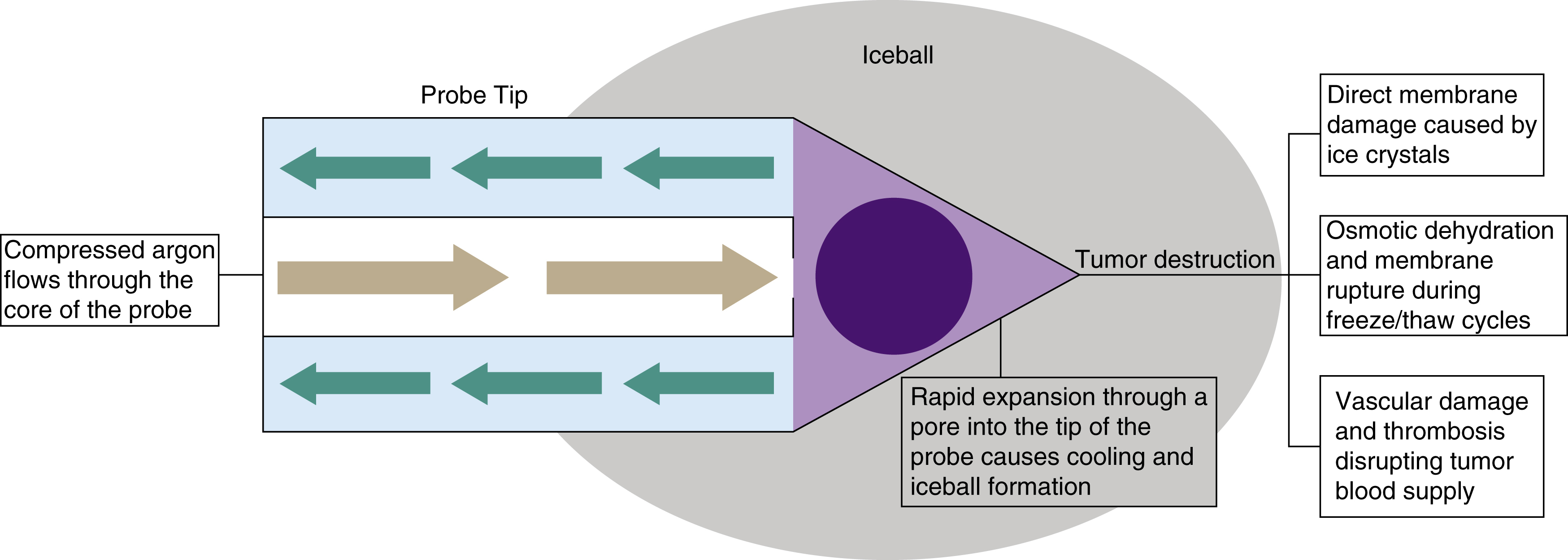 Fig. 98.3, The Joule-Thompson principle demonstrated in a figure of a probe. Compressed argon flows through the center of a probe, where it rapidly decompresses at the tip, causing cooling, and then circulates out of the probe tip. The formation of the iceball causes tumor destruction via several mechanisms.