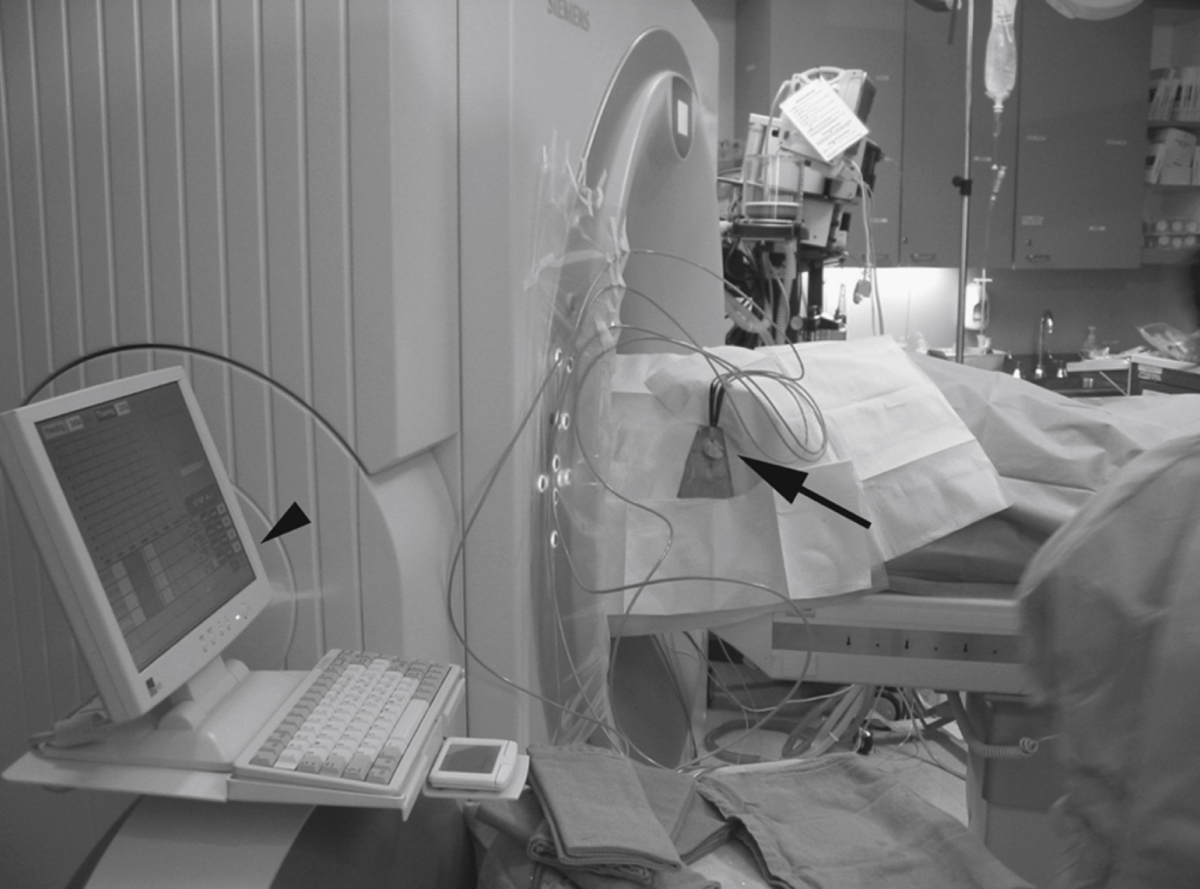 Fig. 98.4, Cryoablation equipment. Contemporary cryoablation systems circulate high-pressure argon gas (and helium) to cryoprobes with the capability of multiple-probe treatments. Here, several 17-gauge probes ( large arrow ) are used for percutaneous computed tomography-guided hepatic tumor ablation. Computer interface (monitor, arrowhead ) provides feedback on ablation temperatures and elapsed time, and allows for individual control of the individual probes.