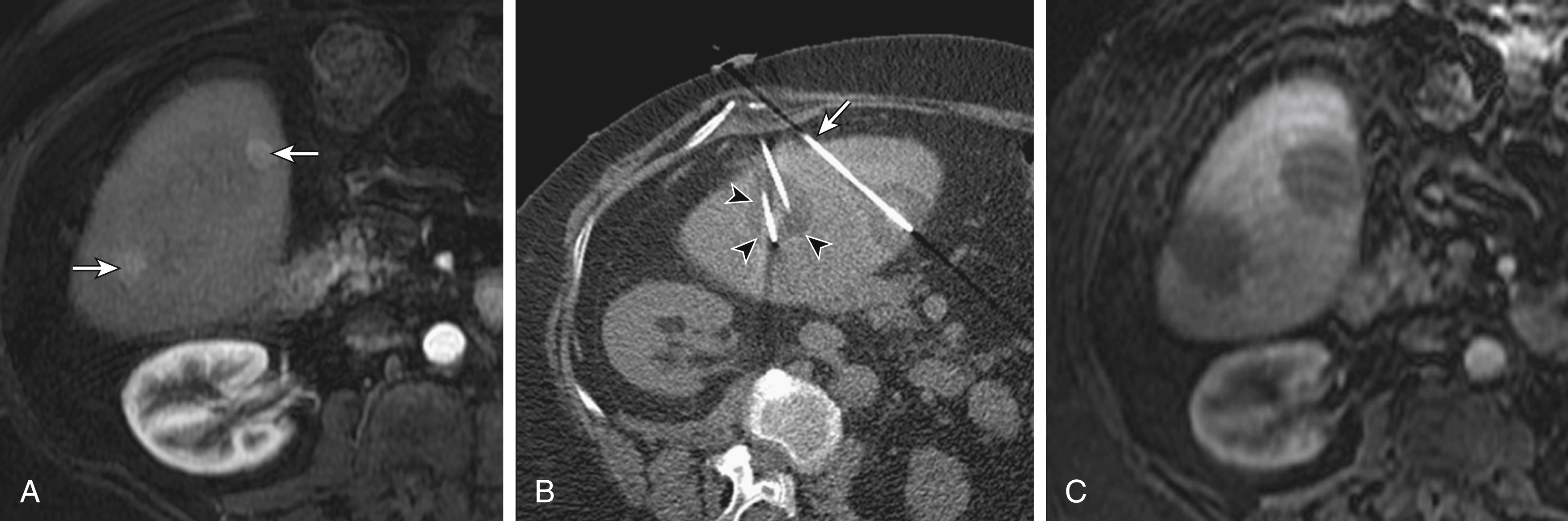 Fig. 98.5, Image-guided cryoablation. (A) Axial contrast-enhanced magnetic resonance image (MRI) identifies two enhancing liver metastases ( arrows ). (B) Unenhanced axial computed tomography (CT) scan shows cryoprobes ( arrow ) placed under CT guidance. The iceball appears as a hypodense rounded shape ( arrowheads ) around the probes. (C) Axial contrast-enhanced postprocedure MRI at 24 hours shows the corresponding nonenhancing regions of ablation covering the tumors, suggesting complete destruction of the metastases.