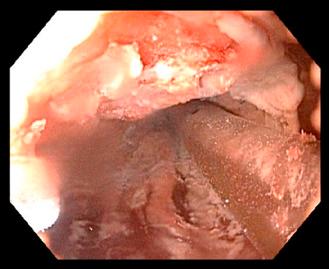 Figure 12.2, LN induced freeze with decompression tube in lumen.