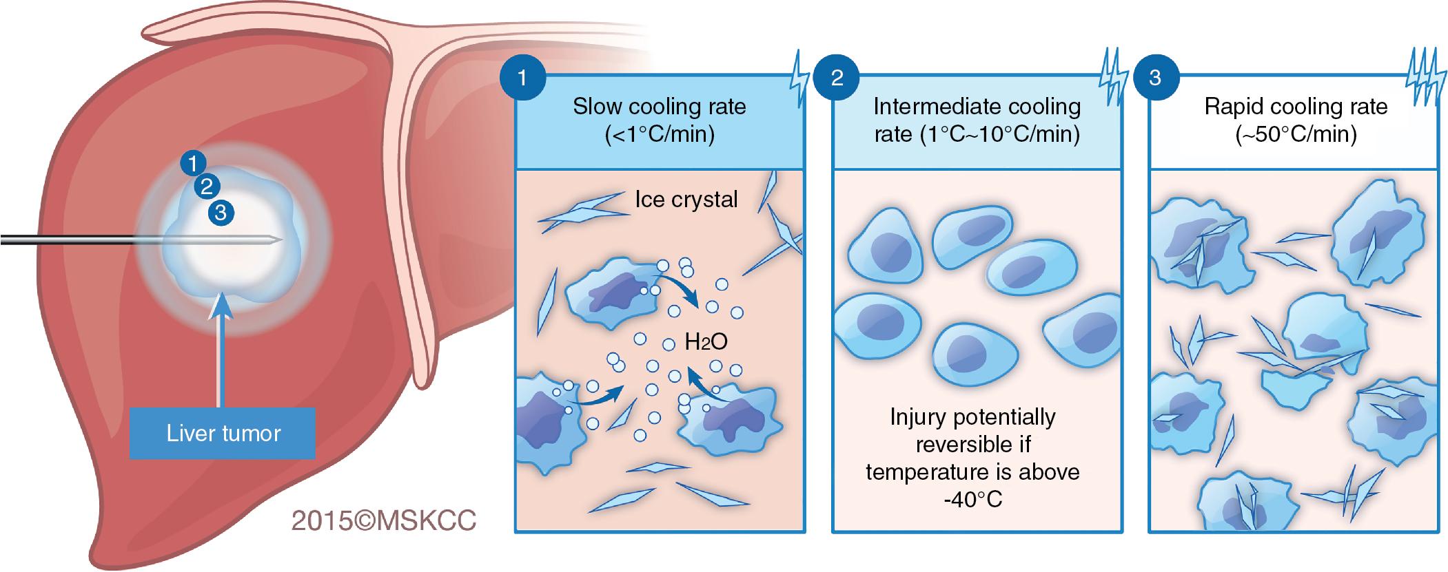 FIGURE 96D.1, Mechanisms of cell death in different cryoablation zones.