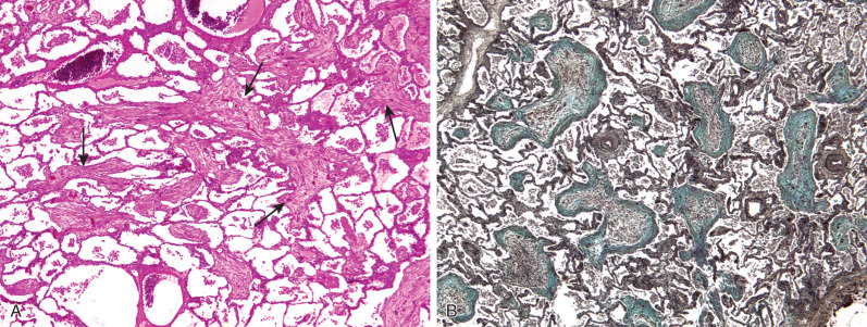 Fig. 29.1, Organizing pneumonia: classic histologic findings. (A) Photomicrograph at low magnification shows characteristic granulation tissue polyps (arrows) in the alveolar ducts and adjacent airspaces. Mild interstitial inflammation also is noted. (B) Movat pentachrome stain highlights the granulation tissue polyps in blue.