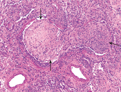 Fig. 29.2, Organizing pneumonia: histologic findings. High-power view shows granulation tissue polyp (Masson body) within bronchiolar lumen (arrows) .