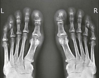 Figure 20-1, This radiograph of the feet of a patient suffering from gout shows fullness of the soft tissues without calcification medial to the left first metatarsophalangeal joint. It also demonstrates erosions of the bones at the periphery of the joint line.