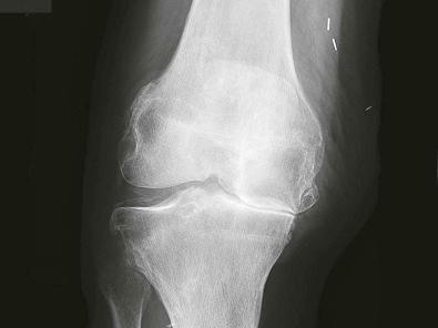 Figure 20-2, This radiograph is of the right knee of a patient who has degenerative narrowing of the medial compartment and calcifications of the lateral meniscus (chondrocalcinosis) due to the deposition of calcium pyrophosphate.