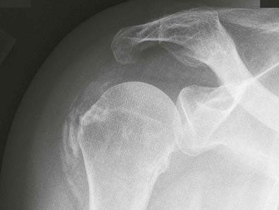 Figure 20-3, This radiograph of the right shoulder of an individual with “calcific capsulitis” shows sizable globular and streaky calcific densities due to hydroxyapatite in the soft tissues lateral to the humeral head and greater tuberosity.