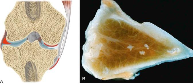 FIGURE 61–2, A , Typical distribution of intraarticular deposition of calcium pyrophosphate. Shown are the meniscal, hyaline cartilage, and entheseal sites of deposition. B , A section through a meniscus confirms the linear superficial deposition as well as the deeper granular foci.