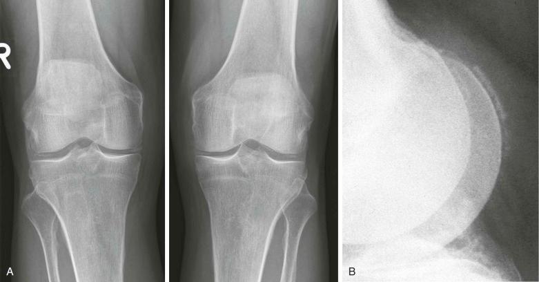 FIGURE 61–3, A , Typical pyrophosphate deposition on knee radiographs. The frontal view conforms to the line drawing in Figure 61-2A . B , The linear nature appears on the lateral view.