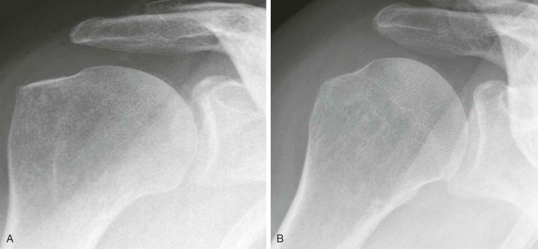 FIGURE 61–4, A and B , Hyaline cartilage chondrocalcinosis in the shoulder joint.