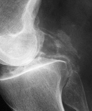 FIGURE 61–5, In cases in which deposition is heaviest, entheseal and capsular calcification may be seen outside of the confines of the joint.