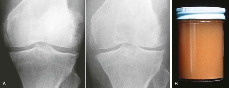 FIGURE 61–6, Crystal shedding associated with clinical pseudogout. A , Two views of the left knee of a middle-aged man who sustained two episodes of pseudogout in the 6 months between these radiographic examinations. On the second examination (right), not only is the calcification less marked, but also the joint space width is reduced. Often, pseudogout occurs as the superficial layers of hyaline cartilage are shed, and the crystals are being released from them. B , Joint aspiration from this patient's second episode of pseudogout shows the puslike nature of the fluid.