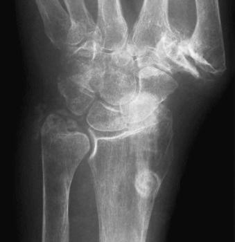 eFIGURE 61–1, Typical case of pseudogout. An elderly woman, in the hospital for another reason, has a venous cannula in her forearm. There is chondrocalcinosis in the triangular fibrocartilage. Clinically, she was suspected of having sepsis in the wrist, but the correct diagnosis was pseudogout.