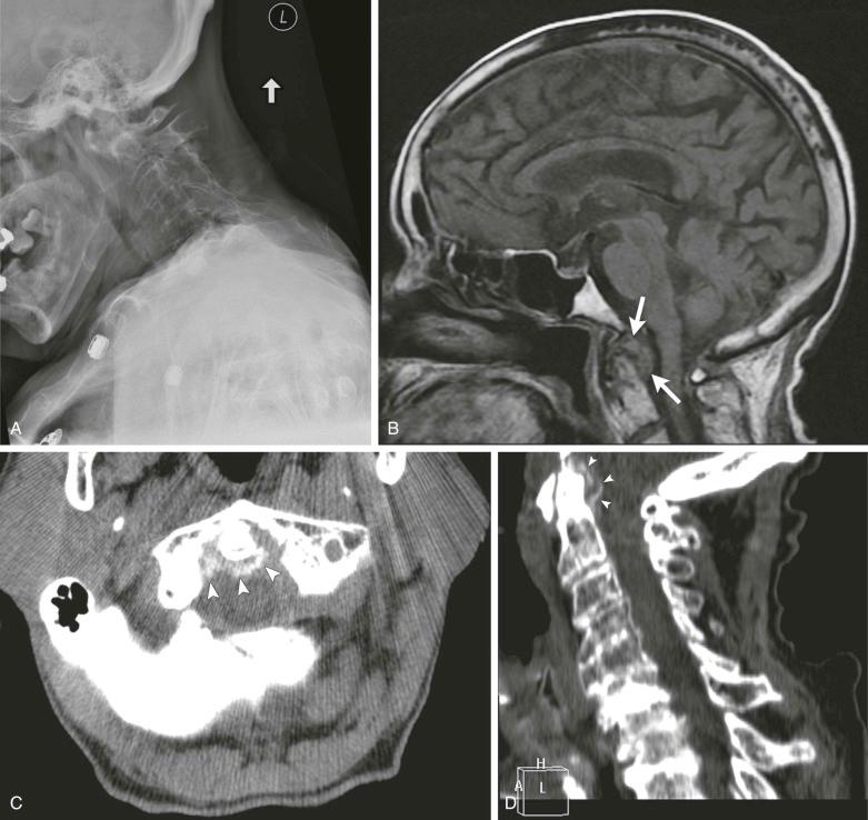 FIGURE 61–7, Images from an 82-year-old woman complaining of severe neck pain and diagnosed with crowned dens syndrome. A , Plain radiographs of the cervical spine show widened pre-dens space. B , Sagittal T1-weighted MRI. Posterior to the dens is an intermediate signal mass (arrows) that is indenting the anterior surface of the pontomedullary area of the cord. Axial ( C ) and sagittal ( D ) CT images show a rim of calcification (arrowheads) in the posterior aspect of the dens likely due to CPPD. CPPD, Calcium pyrophosphate dihydrate.