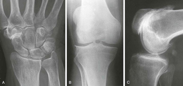 eFIGURE 61–2, Example of patients with osteoarthritis in which somewhat atypical joint involvement has occurred and consideration needed to be given to pyrophosphate arthropathy as a diagnosis. A , Patient does indeed have unusual scaphotrapezial osteoarthritis with chondrocalcinosis of the triangular fibrocartilage. B and C , However, this is a case of severe patellofemoral osteoarthritis with virtually normal tibiofemoral compartments. No pyrophosphate could be found on joint aspiration. Is the apparent association between atypical joint involvement and pyrophosphate real or simply part of the spectrum of osteoarthritis?