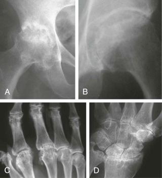 FIGURE 61–8, Multiple subchondral radiolucencies (cysts) occur in a number of conditions involving iron and calcium metabolism. These lesions occur in conjunction with pyrophosphate deposition ( A ) and hemochromatosis ( B ). Further examples of the latter are shown involving the metacarpophalangeal joints ( C ) and the wrist ( D ).