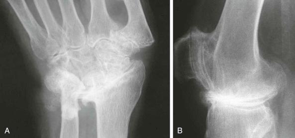 eFIGURE 61–3, Marked osteophyte formation in the wrist ( A ) and the knee ( B ). These huge osteophytes are a marker of hypertrophic osteoarthritis and are part of the spectrum of CPPD. CPPD, Calcium pyrophosphate dihydrate.