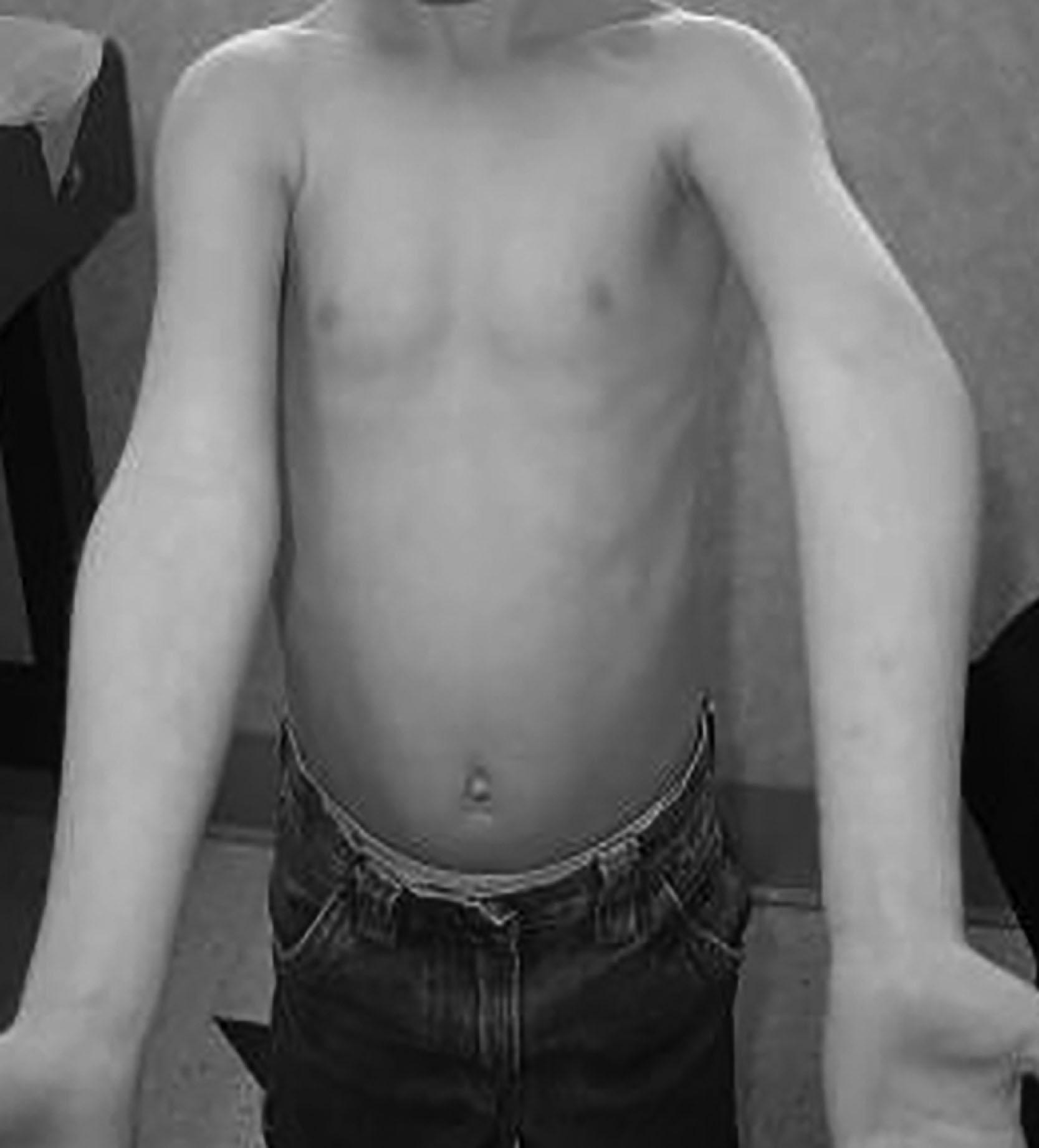 Fig. 19.1, A Preoperative Clinical Photo of a 9-Year-Old Boy. He has a cubitus varus deformity of the left elbow stemming from a malunion of a prior supracondylar fracture at age 7 years.