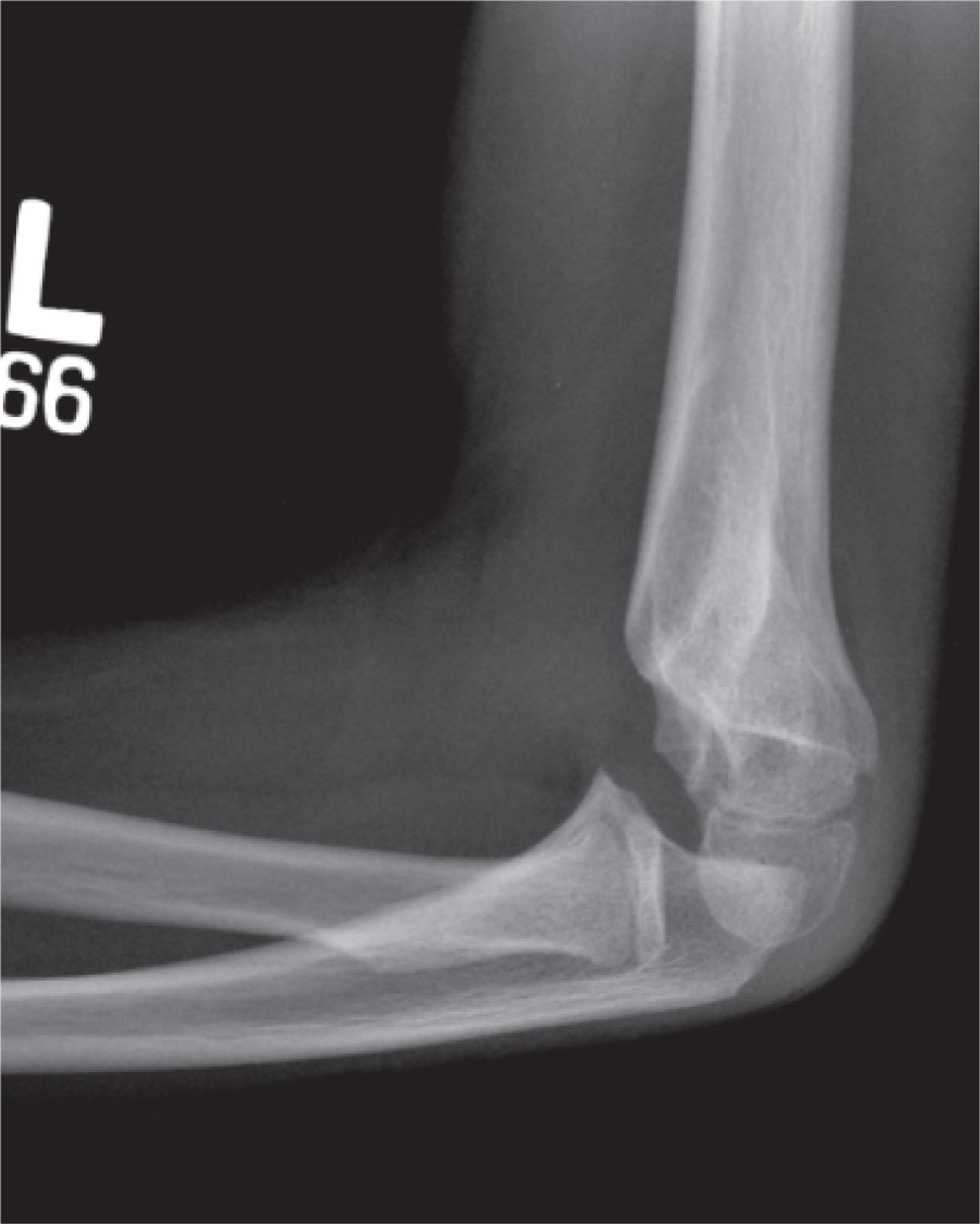 Fig. 19.3, Preoperative Lateral X-Ray of the Left Elbow Demonstrating Varus and Extension Deformities.