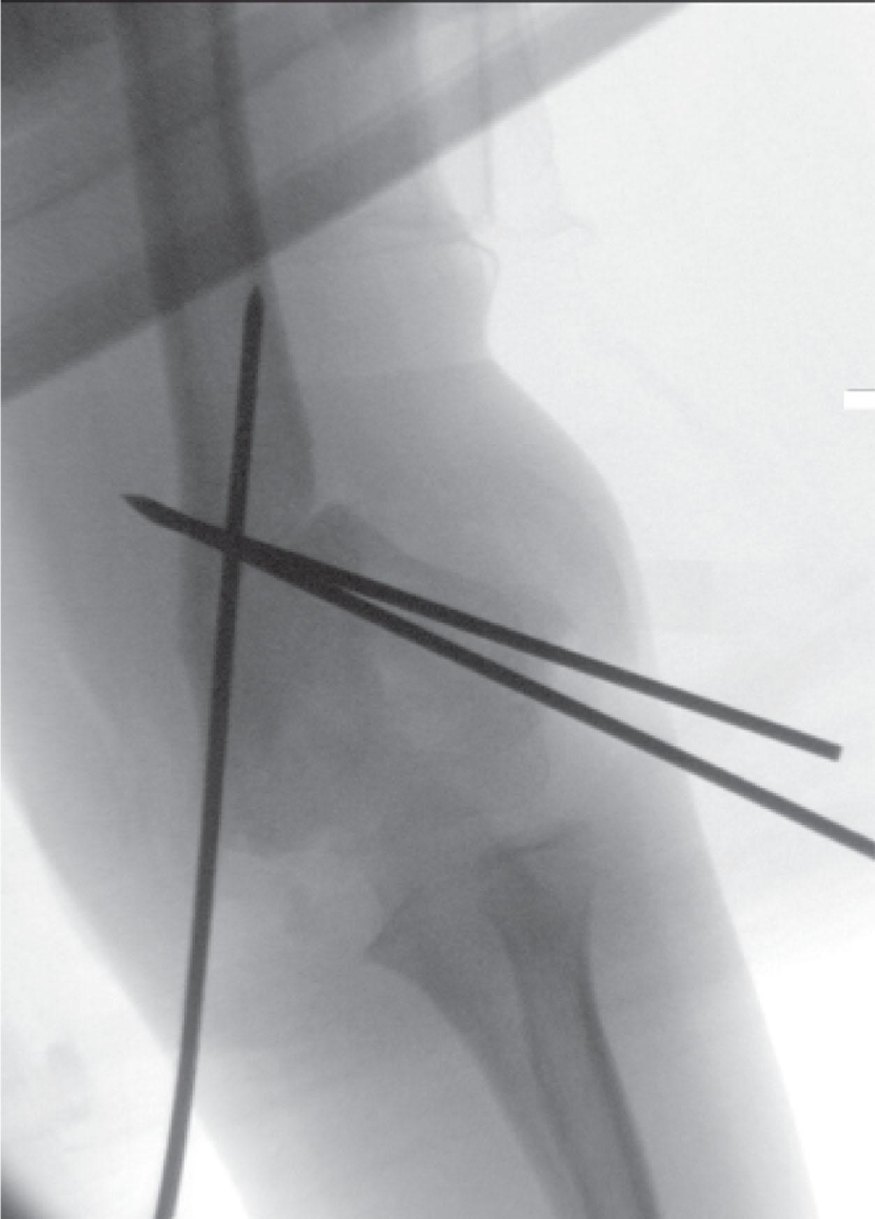 Fig. 19.4, Intraoperative Anteroposterior Radiograph Demonstrating Dual Plane Correction of the Varus and Extension with Smooth K-Wire Fixation.