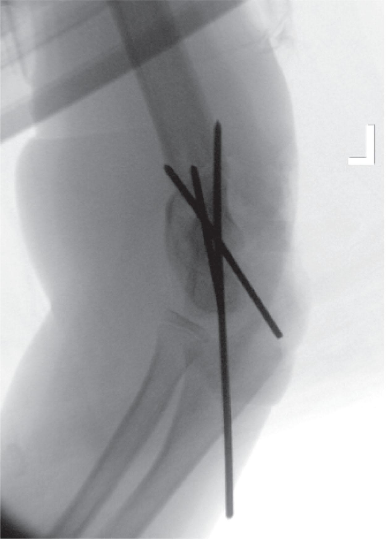 Fig. 19.5, Intraoperative Lateral Radiograph Demonstrating Dual Plane Correction of the Varus and Extension with Smooth K-Wire Fixation.