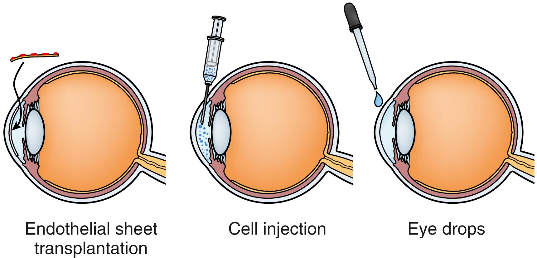 Fig. 139.1, Schema illustrating a future therapeutic modality for corneal endothelial disease.