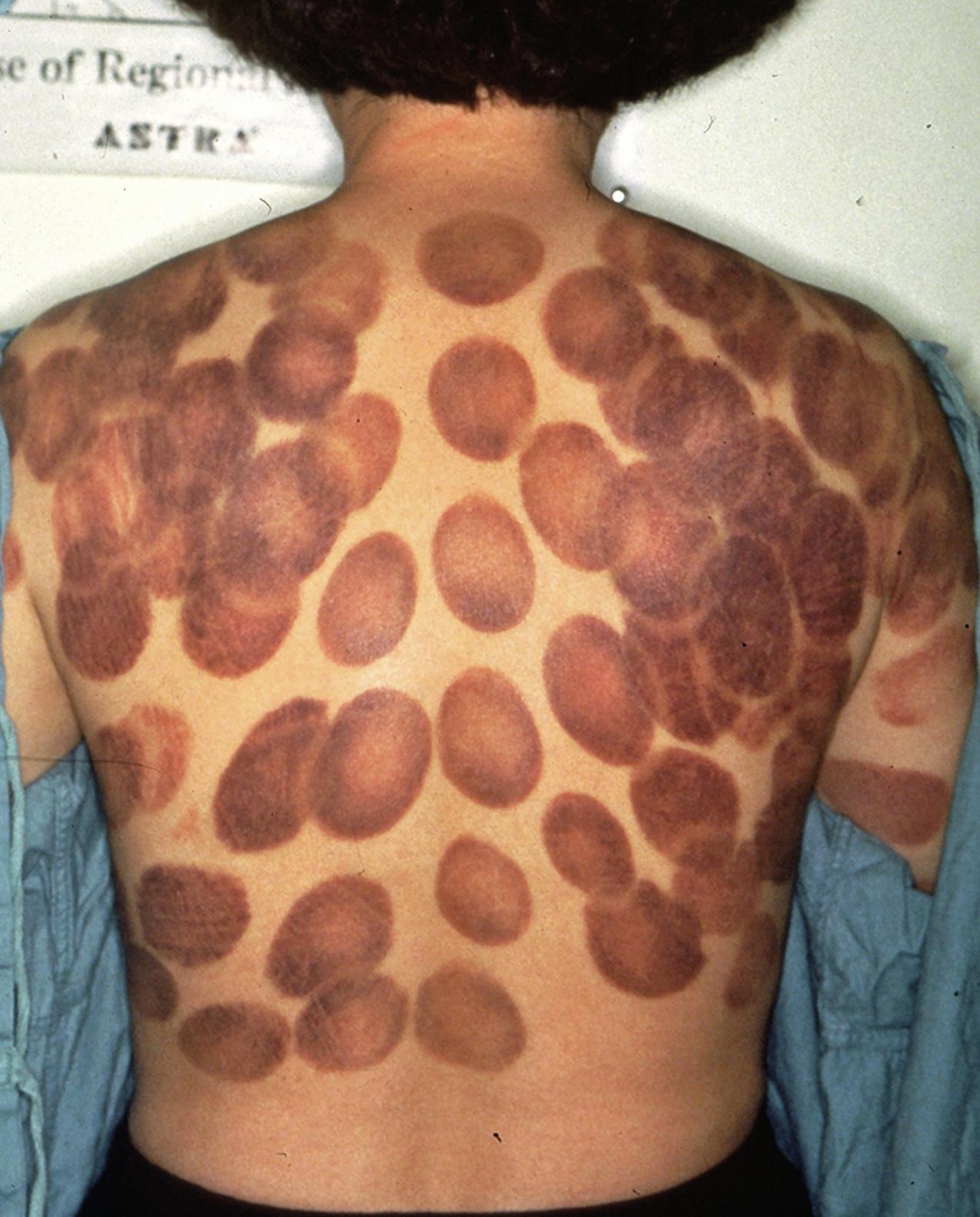 Fig. 64.1, Chinese woman with numerous sharply demarcated hemorrhagic lesions of the back due to cupping therapy.