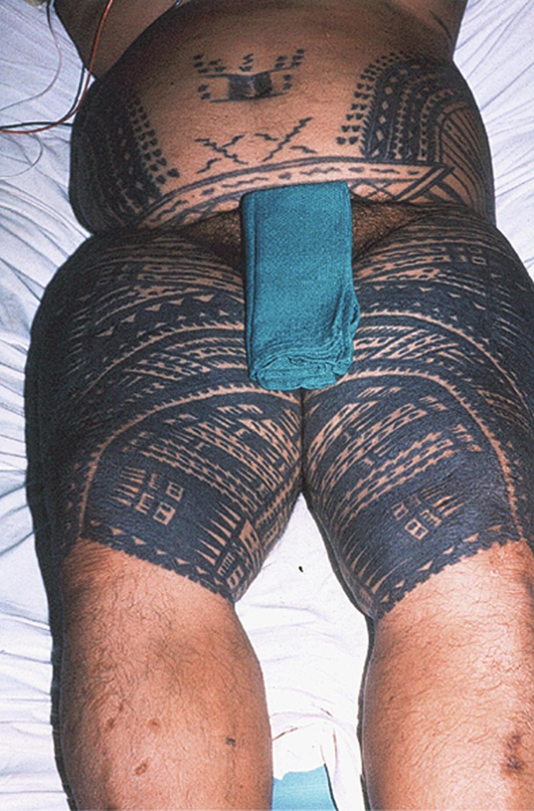 Fig. 64.2, A Samoan man with extensive and elaborate cultural tattoo. The traditional patterns of Polynesian tattoos are distinctive for each island or island group.