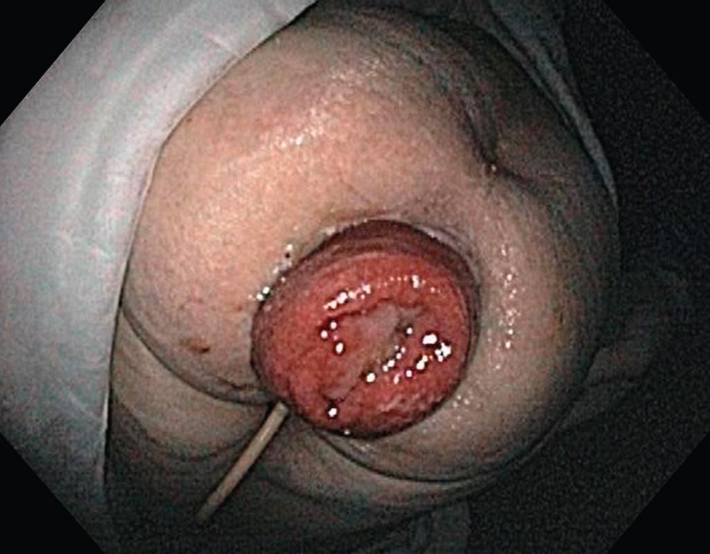 FIGURE 152.1, Full-thickness rectal prolapse with concentric rings.