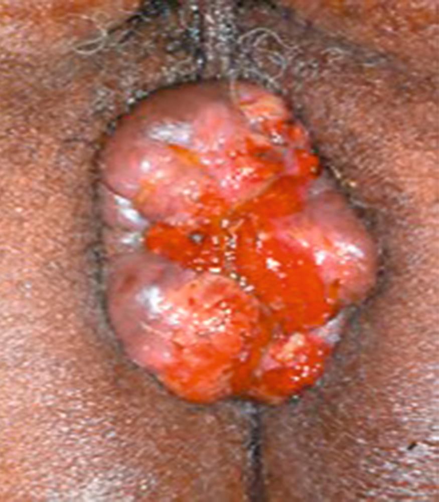 FIGURE 152.2, Radial folds of severe hemorrhoidal prolapse.